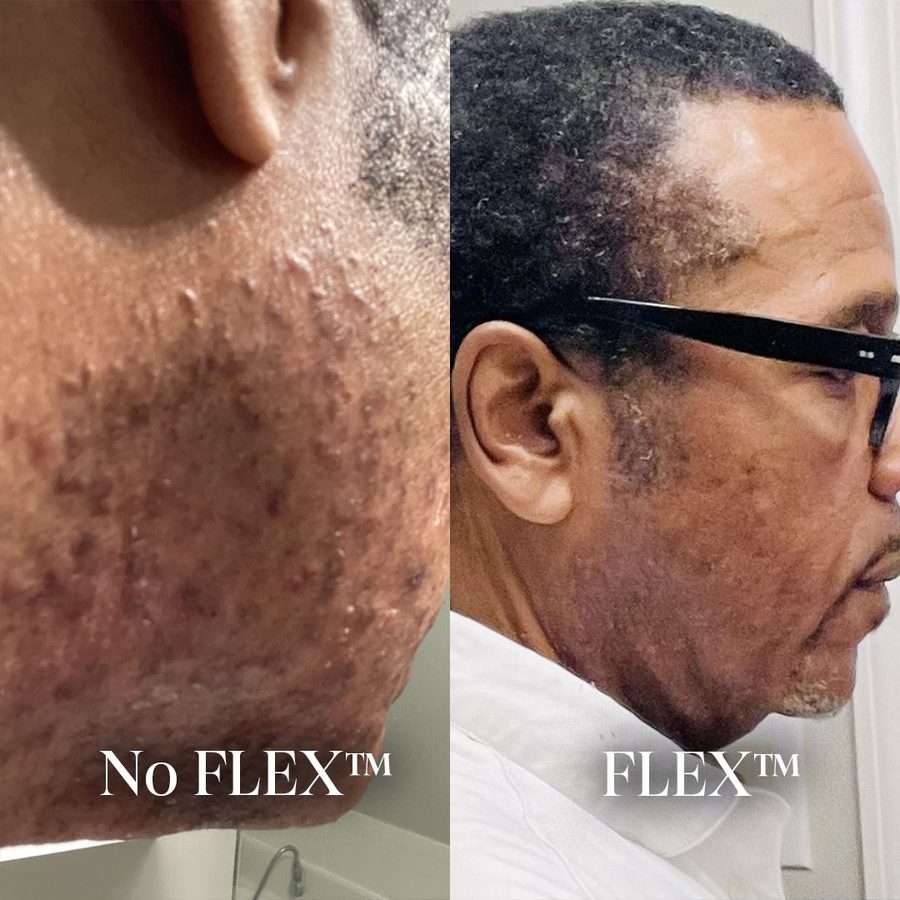 Razor bumps along the jaw and neck