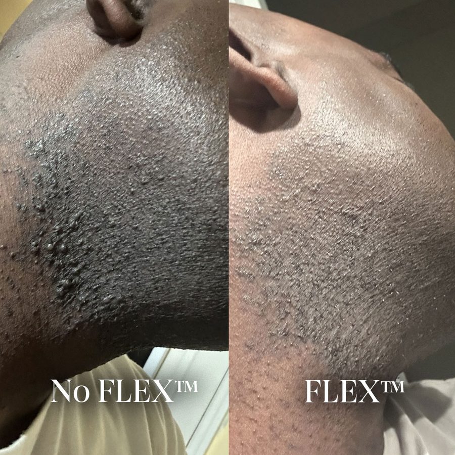 Razor bumps along the jawline, before and after