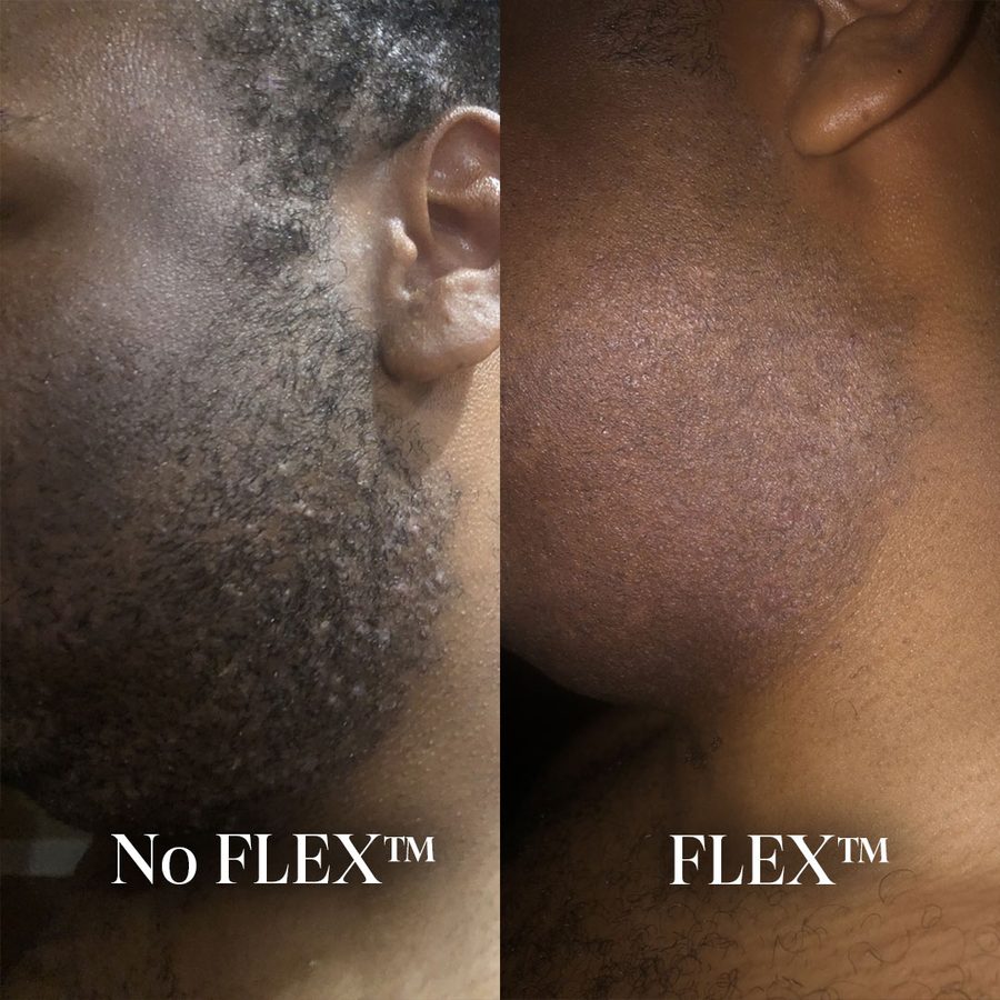 Razor bumps with flaking across the jaw and upper neck, before and after