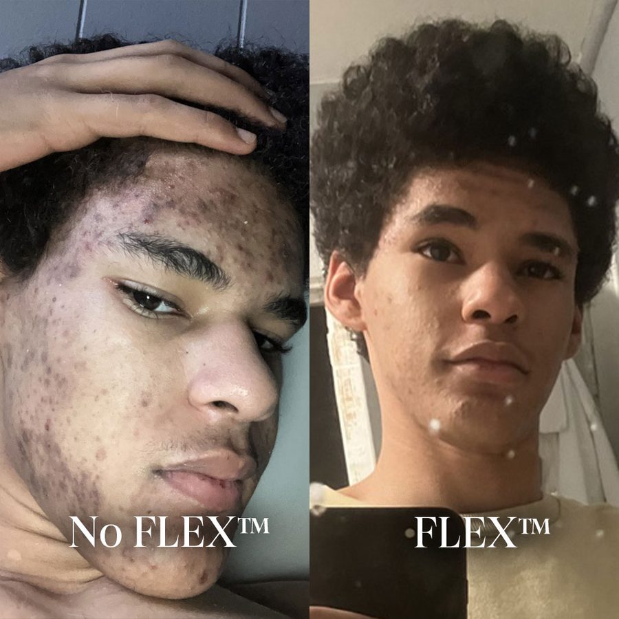 Acne and dark marks, before and after