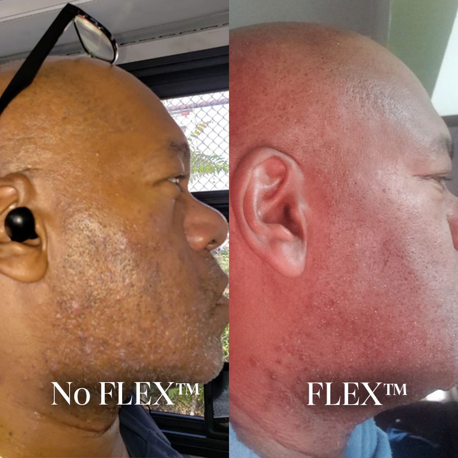 Ingrown hairs on the neck, before and after