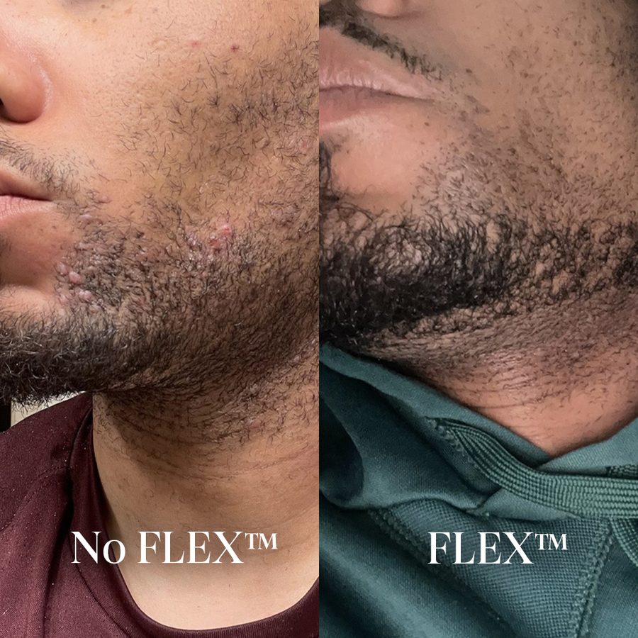 Ingrown papules along the jawline under a beard, before and after
