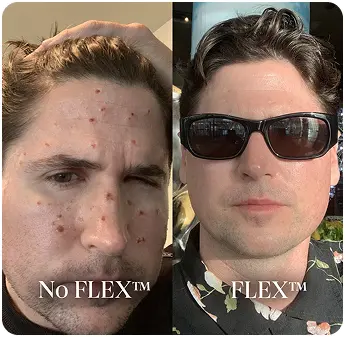 Before/After FLEX