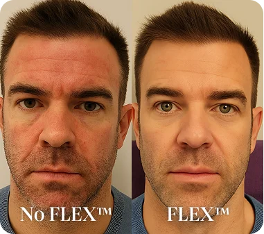 Before/After FLEX