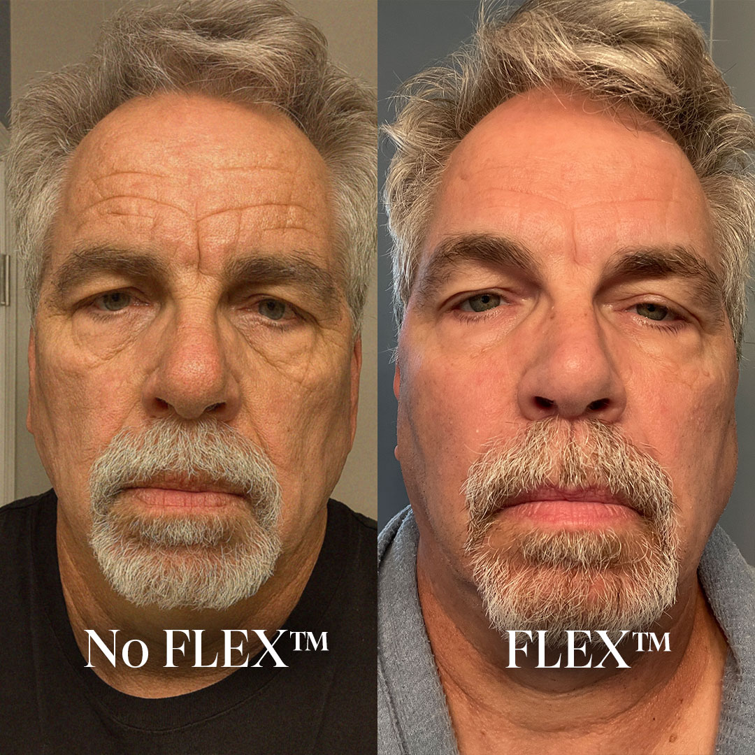 Before and After FLEX Results