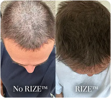 Before/After RIZE