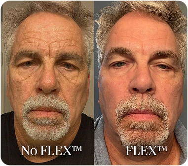 Before/After FLEX
