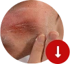 Razor bumps visual